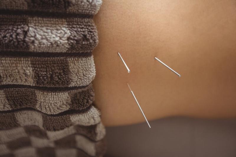 Acupuntura Cervical: Como Essa Terapia Pode Aliviar Dores e Melhorar Seu Bem-Estar