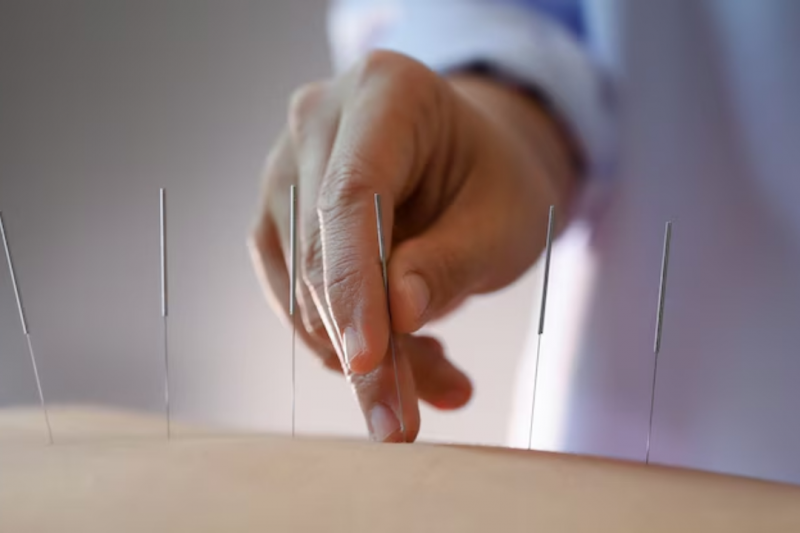 Acupuntura RJ: Descubra os Benefícios e Onde Encontrar Acupuntura RJ: Descubra os Benefícios e Onde Encontrar