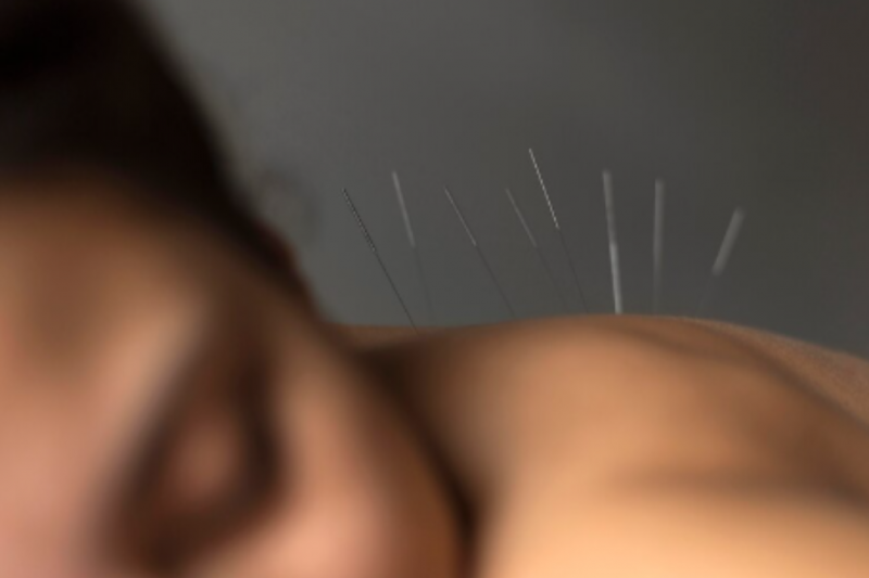 Acupuntura Cervical como Tratamento Eficaz para Dores no Pescoço Acupuntura Cervical como Tratamento Eficaz para Dores no Pescoço