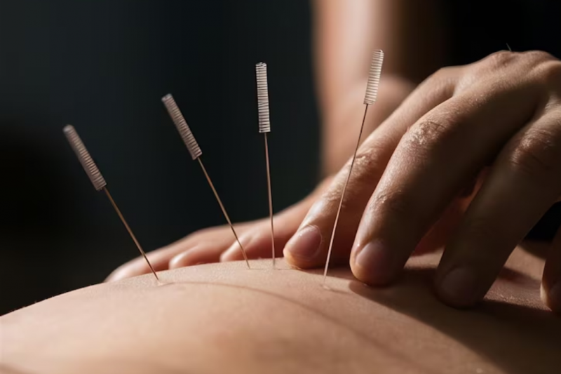 Como escolher o melhor acupunturista para suas necessidades de saúde