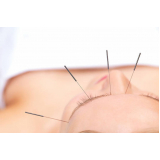 acupuntura para enxaqueca consulta Anil