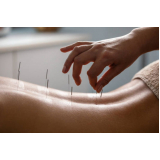acupuntura nervo ciático Maracanã